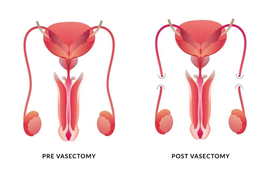 Cos’è la vasectomia maschile: ecco cosa sapere