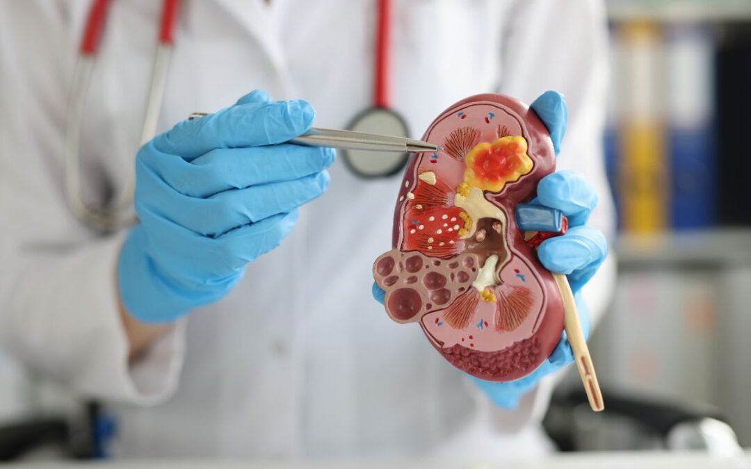 Calcoli renali in estate: cause, prevenzione e cure