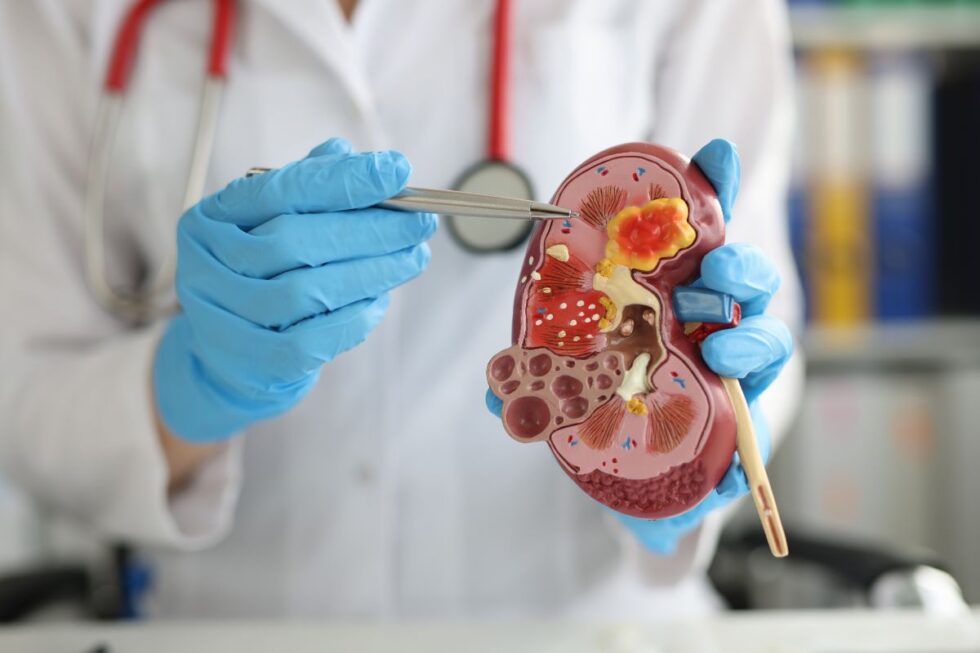 calcoli-renali-in-estate-cause-prevenzione-e-cure